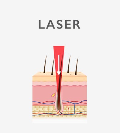 Laser — single controlled beam targeting hair follicle