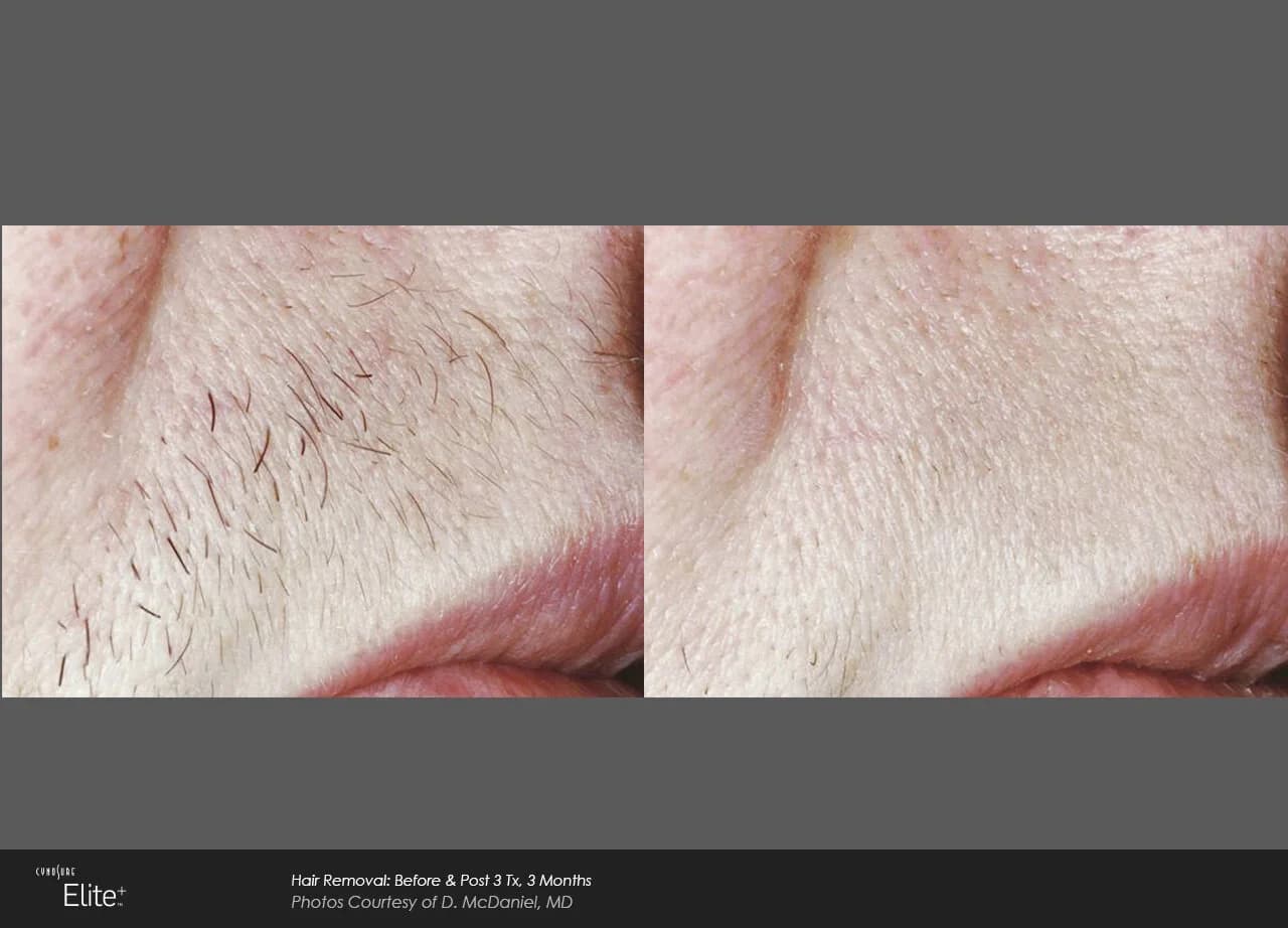 Hair Removal: Before & Post 3 Tx, 3 Months — D. McDaniel, MD