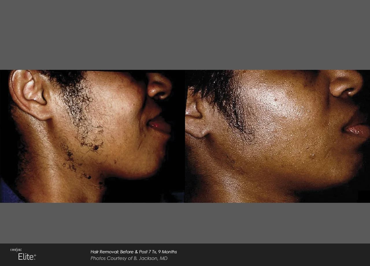 Hair Removal: Before & Post 7 Tx, 9 Months — B. Jackson, MD